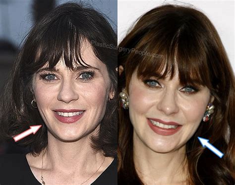 zooey deschanel facelift|Zooey Deschanel: Before and After